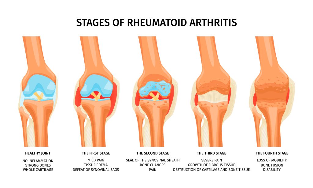 Tahap sakit tulang arthritis