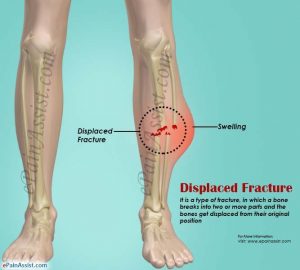 Patah Tulang Ada Berapa Jenis Sebenarnya Flexphysiotherapy
