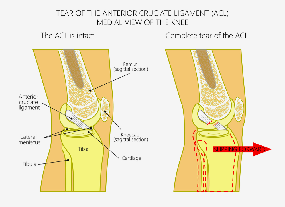 ligamen-lutut-koyak-tak-sembuh-dengan-mengurut-flexphysiotherapy