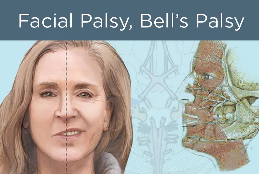 Cara Mudah untuk Merawat Bell’s Palsy