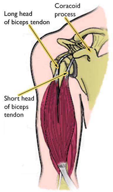 Simptom Bicep Tendinitis Beza Sakit Bahu Biasa Flexphysiotherapy