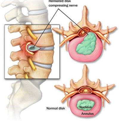 Simptom Slipped Disc ramai orang abaikan