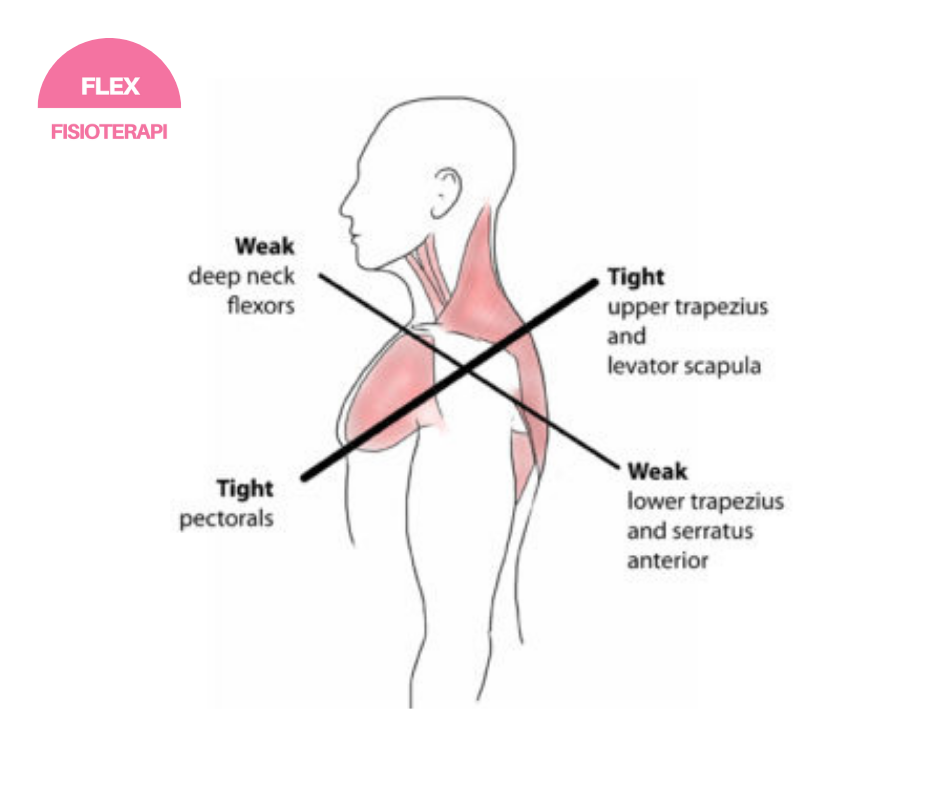 Lower Crossed Syndrome dan cara mengatasinya