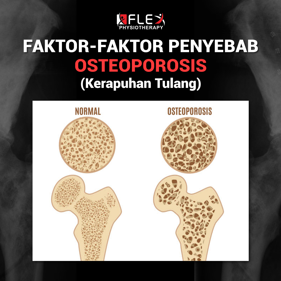 Lima tanda osteoporosis