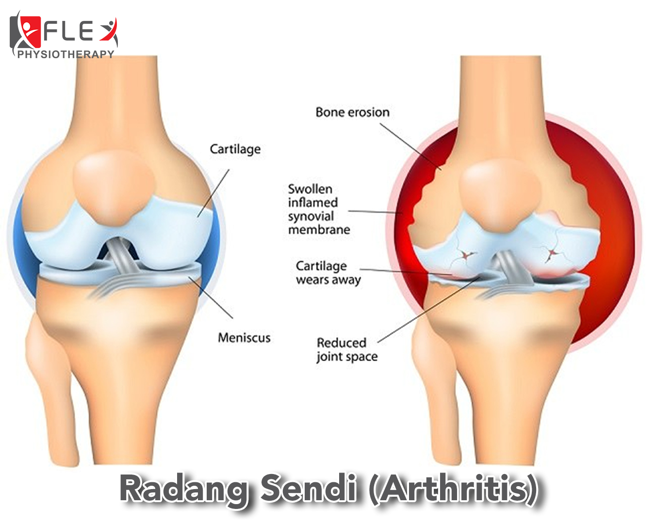 5 CARA MUDAH ELAK SAKIT LUTUT