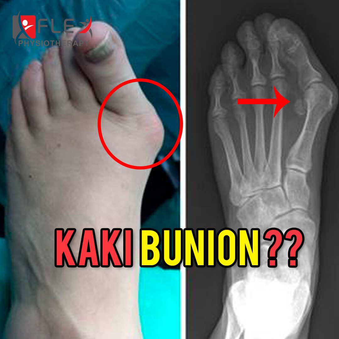 Bunion, ramai tak tahu simptom sebenar