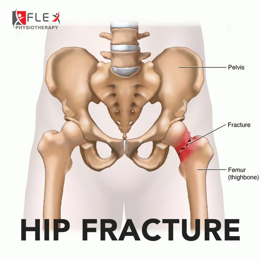 Hip Fracture: Gejala, Punca dan Langkah Pemulihan