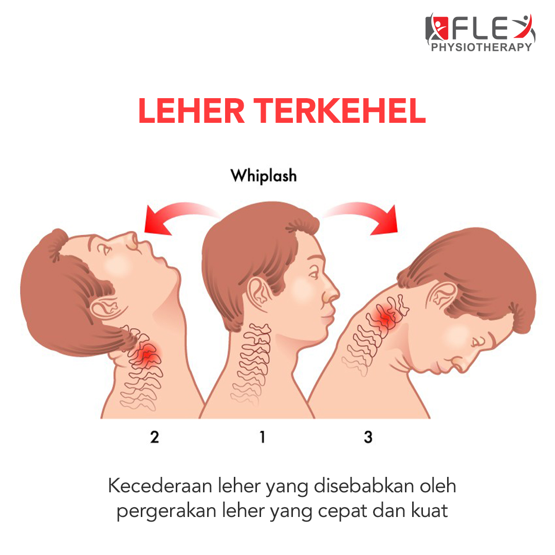 Atasi Sakit Leher Akibat Salah Tidur Dengan Cara Ini Flexphysiotherapy