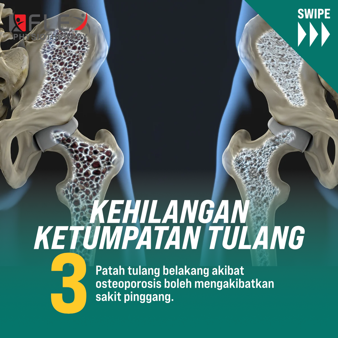 Sakit Pinggang Disebabkan Oleh Osteoporosis